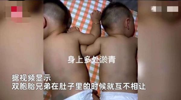 双胞胎在肚内打架致淤青？医生：槽多无口